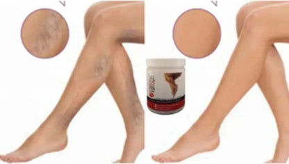 Kremi 200ML / Varison Varicose Veins Cream 200ML x 2 Adet